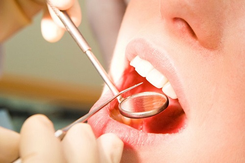 Lấy cao răng có ảnh hưởng không? Nha sĩ tư vấn 2