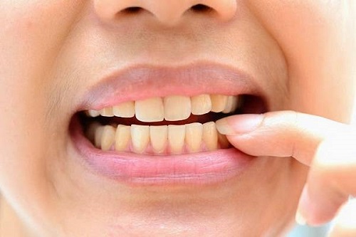 Tẩy trắng răng bằng máng bao nhiêu tiền? Nha khoa giải đáp 1