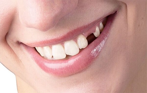 Có nên trồng răng sứ kim loại không? Vì sao? 1