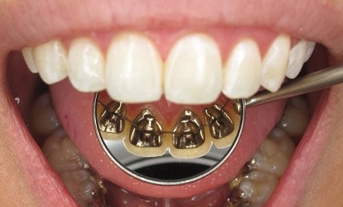 Niềng răng mặt trong mất bao lâu? Nha khoa giải đáp 1 Niềng răng mặt trong mất bao lâu? Nha khoa giải đáp 1