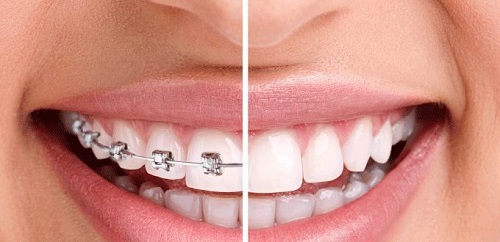 Niềng răng mắc cài inox giá bao nhiêu là thực hiện được? 3