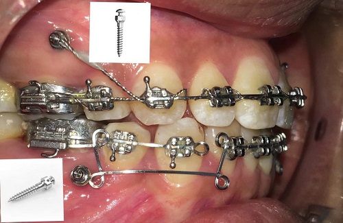 Cắm vít niềng răng bị sưng - Nha khoa nói gì? 2 Cắm vít niềng răng bị sưng - Nha khoa nói gì? 2
