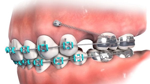 Cắm vít niềng răng bị sưng - Nha khoa nói gì? 3 Cắm vít niềng răng bị sưng - Nha khoa nói gì? 3