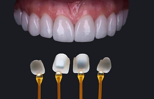 Làm răng sứ không mài răng - Tìm hiểu ngay 3