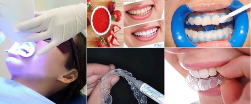 Tẩy trắng răng bằng máng có tốt không? Tìm hiểu 2