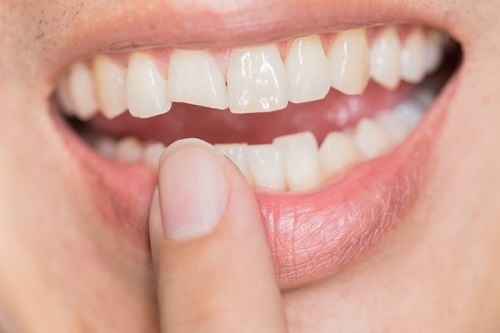 Răng sứ có tháo ra được không? Giải pháp khắc phục 3 Răng sứ có tháo ra được không? Giải pháp khắc phục 3