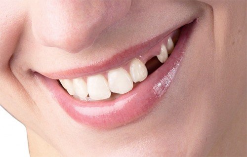 Trồng răng bị rụng - Phục hình hiệu quả từ nha khoa 1 Trồng răng bị rụng - Phục hình hiệu quả từ nha khoa 1