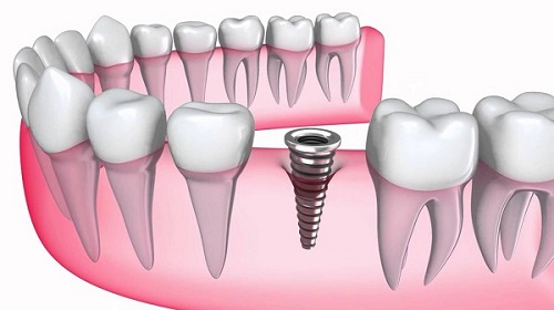 Trồng răng bị rụng - Phục hình hiệu quả từ nha khoa 2