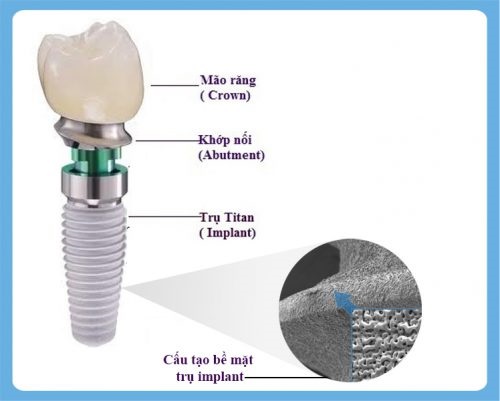 Trồng răng bị rụng - Phục hình hiệu quả từ nha khoa 3 Trồng răng bị rụng - Phục hình hiệu quả từ nha khoa 3