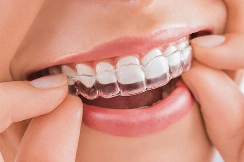 Dụng cụ niềng răng tại nhà 3 giai đoạn - Thông tin cần biết 3