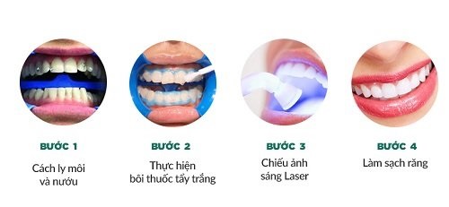 Niềng răng xong có nên tẩy trắng răng? Thông tin nha khoa 2