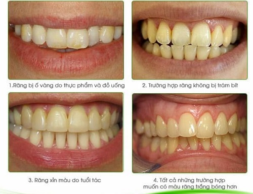 Niềng răng xong có nên tẩy trắng răng? Thông tin nha khoa 3 Niềng răng xong có nên tẩy trắng răng? Thông tin nha khoa 3