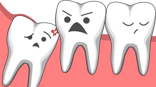 Chụp x quang răng khôn bao nhiêu tiền? Tham khảo ngay 1