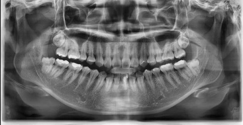 Răng khôn mọc kẹt - Phương pháp xử lý dứt điểm 1