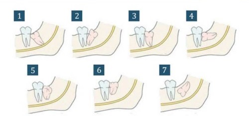 Răng khôn hàm trên mọc ngầm nên làm gì? 2