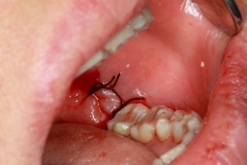 Răng khôn bị sâu chảy máu - Phương pháp điều trị 1