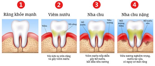 Răng khôn bị sâu chảy máu - Phương pháp điều trị 2