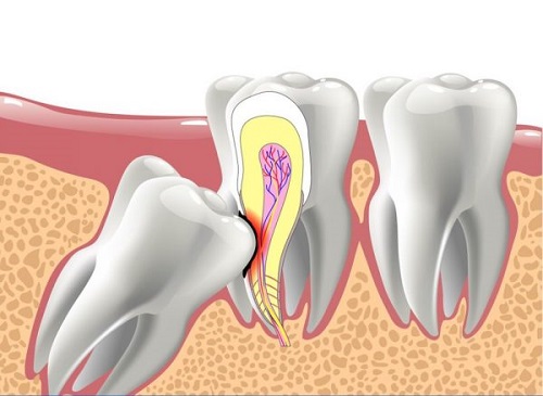 Răng khôn bị viêm có nguy hiểm không? 1 Răng khôn bị viêm có nguy hiểm không? 1