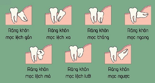 Răng khôn hàm trên bị sâu - Phương pháp xử lý 2