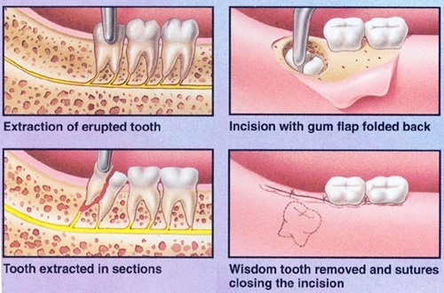Đau răng khôn dẫn đến đau tai nên xử lý sao? 3