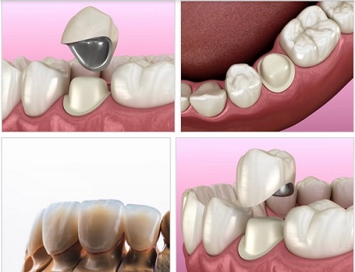 Trồng răng sứ có lâu không? Tìm hiểu quy trình 3 Trồng răng sứ có lâu không? Tìm hiểu quy trình 3