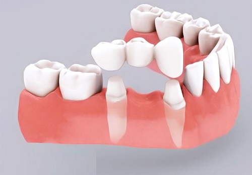Kỹ thuật trồng răng sứ không thể "Bỏ qua" 2 Kỹ thuật trồng răng sứ không thể "Bỏ qua" 2