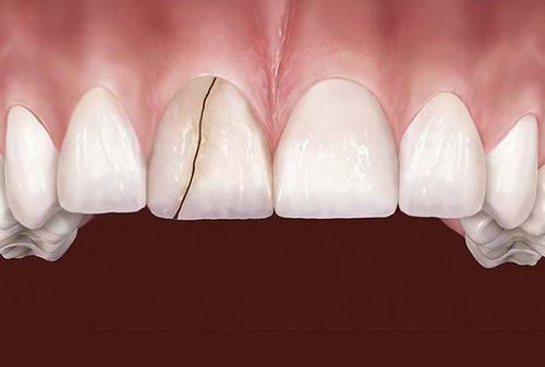 Răng sứ bị nứt - Phương pháp khắc phục hiệu quả 1