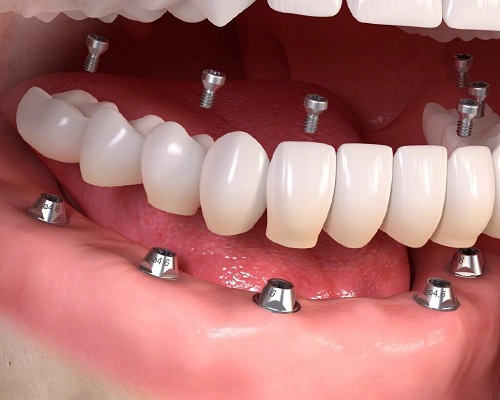 Trồng răng sứ có ảnh hưởng gì không? Tìm hiểu 2