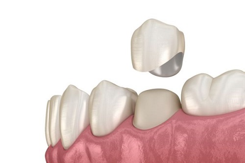Răng sứ bị hỏng - Nguyên nhân do đâu? 2
