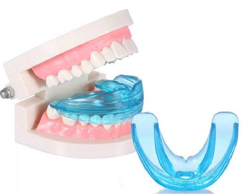 Dụng cụ niềng răng tại nhà có tốt không? Tìm hiểu thêm 2