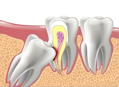 Răng khôn hàm trên bị vỡ - Cách xử lý kịp thời 1