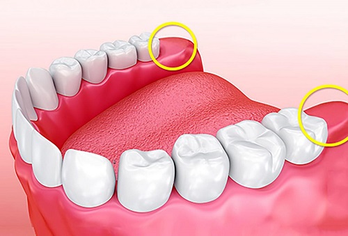 Răng khôn không đau có cần nhổ không? Chuyên gia tư vấn 1 Răng khôn không đau có cần nhổ không? Chuyên gia tư vấn 1