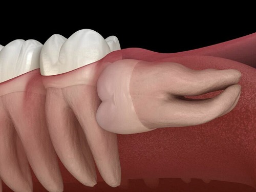 Răng khôn không đau có cần nhổ không? Chuyên gia tư vấn 3