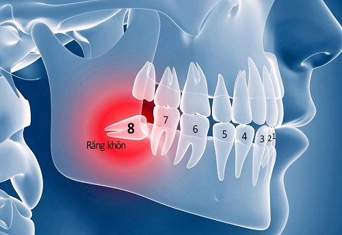 Răng khôn làm sâu răng số 7 nên nhổ hay điều trị sâu răng? 2