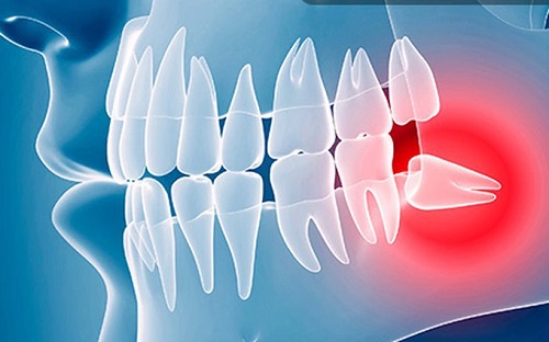Răng khôn làm sâu răng số 7 nên nhổ hay điều trị sâu răng? 3