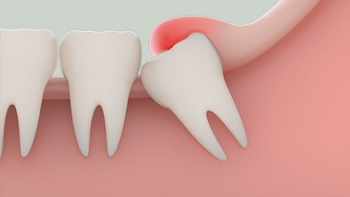 Răng khôn làm sưng mặt phải làm sao? 2 Răng khôn làm sưng mặt phải làm sao? 2