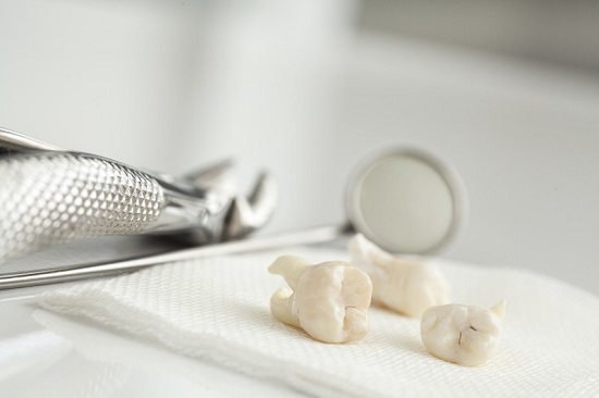 Nhổ 2 răng khôn hàm trên trong trường hợp nào? 3 Nhổ 2 răng khôn hàm trên trong trường hợp nào? 3